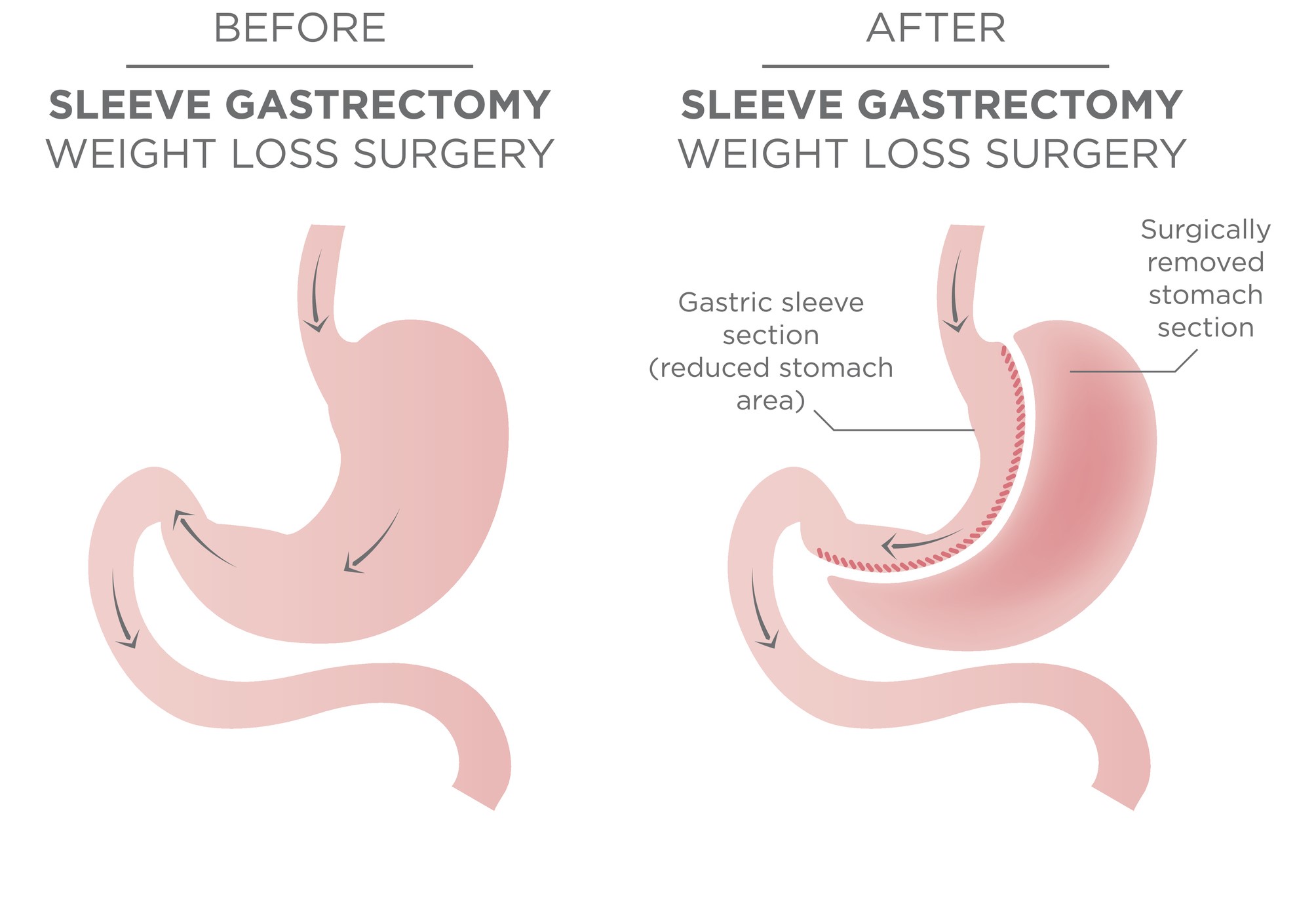 gastric sleeve revision